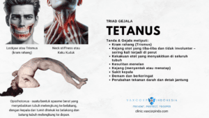 Vaksinasi Tetanus - Tanda & Gejala Tetanus