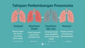 Tahapan Perkembangan Pneumonia