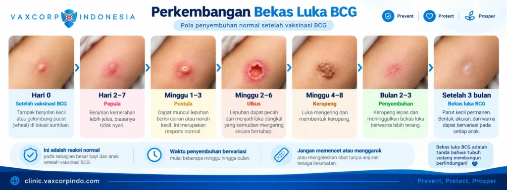 Perkembangan Bekas Luka Vaksin BCG
